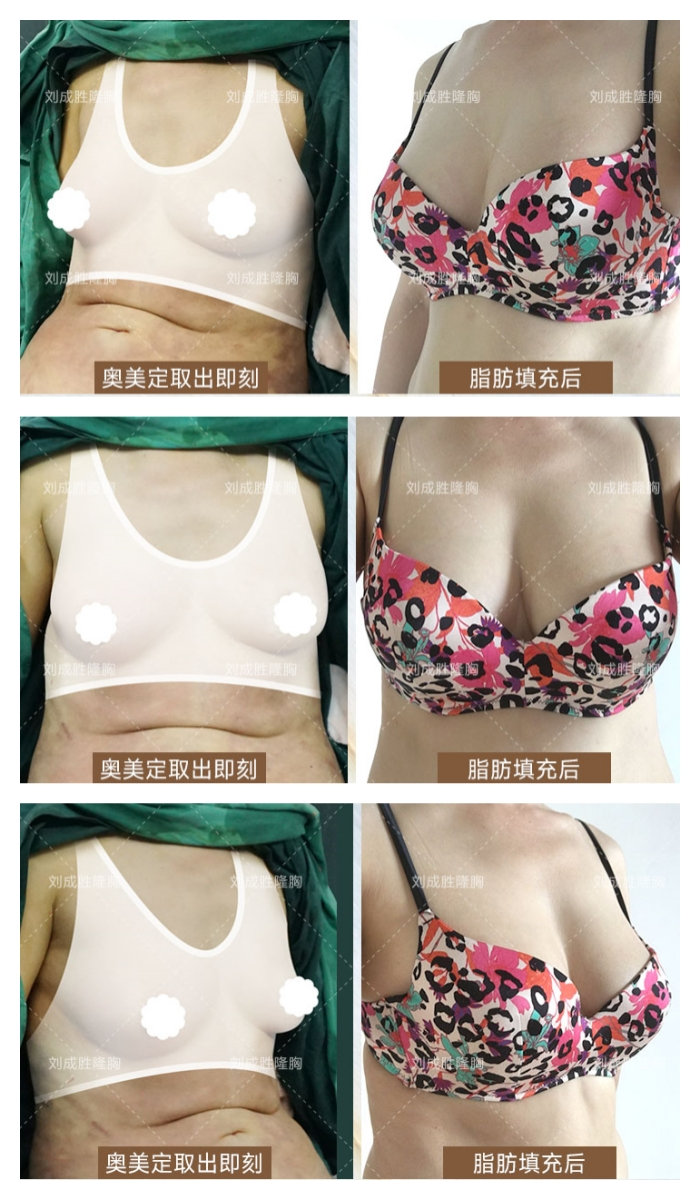 丰体针丰胸是否值得？风险与效果的全面比较